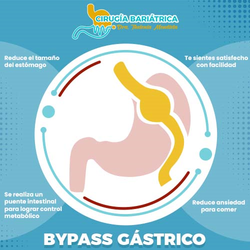 Bypass Gástrico