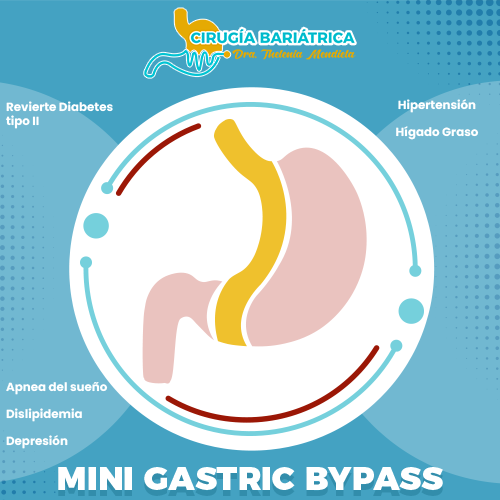 Mini Gastric Bypass